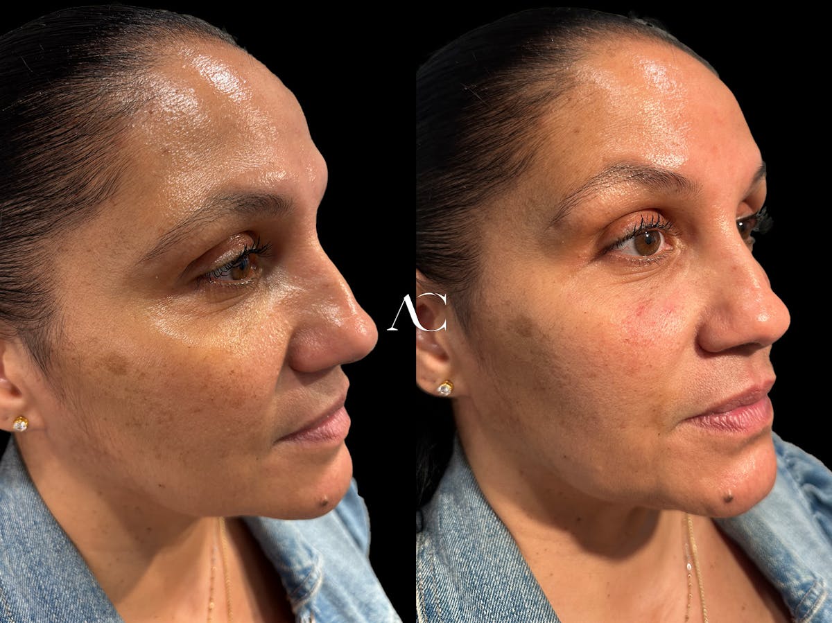 Facial Rejuvenation Before & After Gallery - Patient 138079 - Image 2