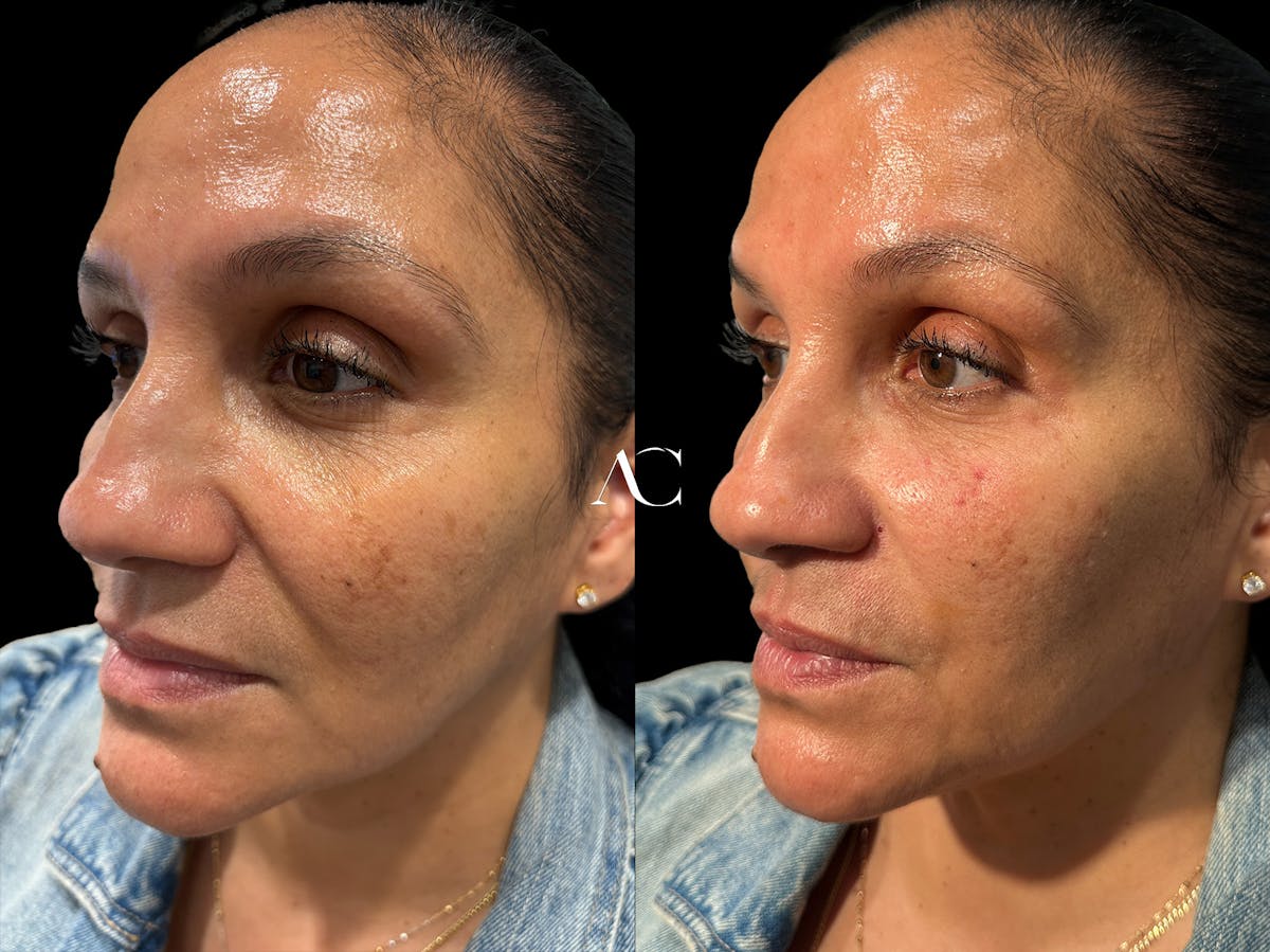 Facial Rejuvenation Before & After Gallery - Patient 138079 - Image 3
