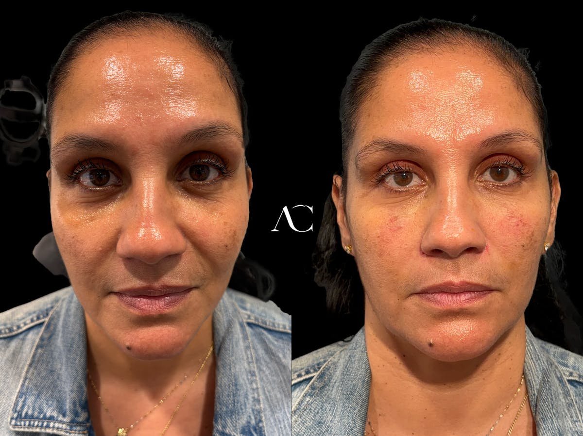 Facial Rejuvenation Before & After Gallery - Patient 138079 - Image 1