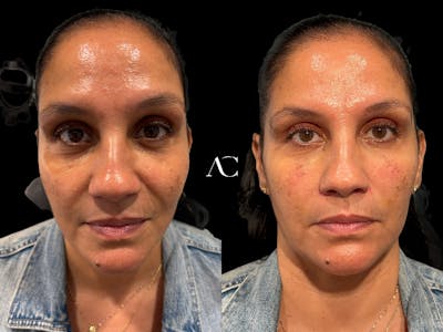 Facial Rejuvenation Before & After Gallery - Patient 138079 - Image 1