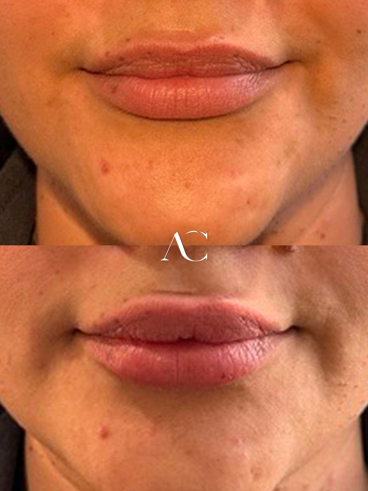 Lip Filler Before & After Gallery - Patient 233380 - Image 1