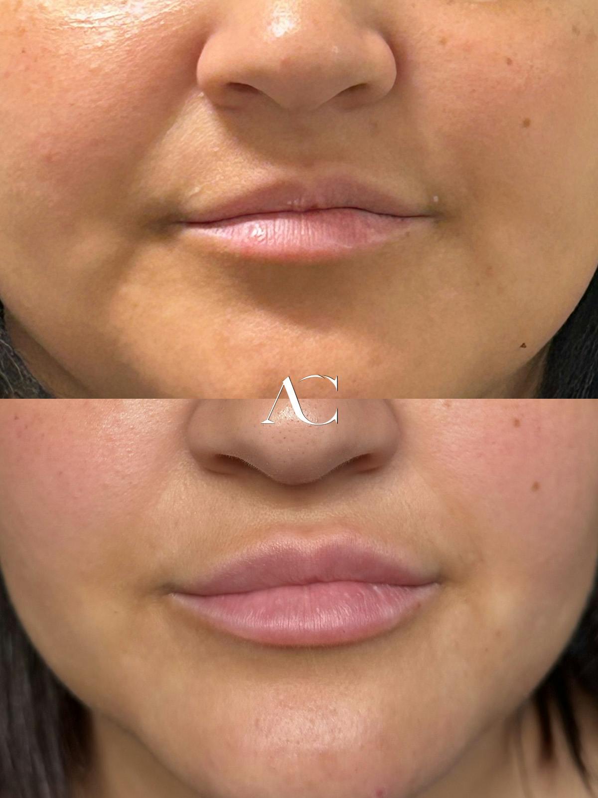 Lip Filler Before & After Gallery - Patient 124307 - Image 1