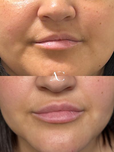 Lip Filler Before & After Gallery - Patient 124307 - Image 1