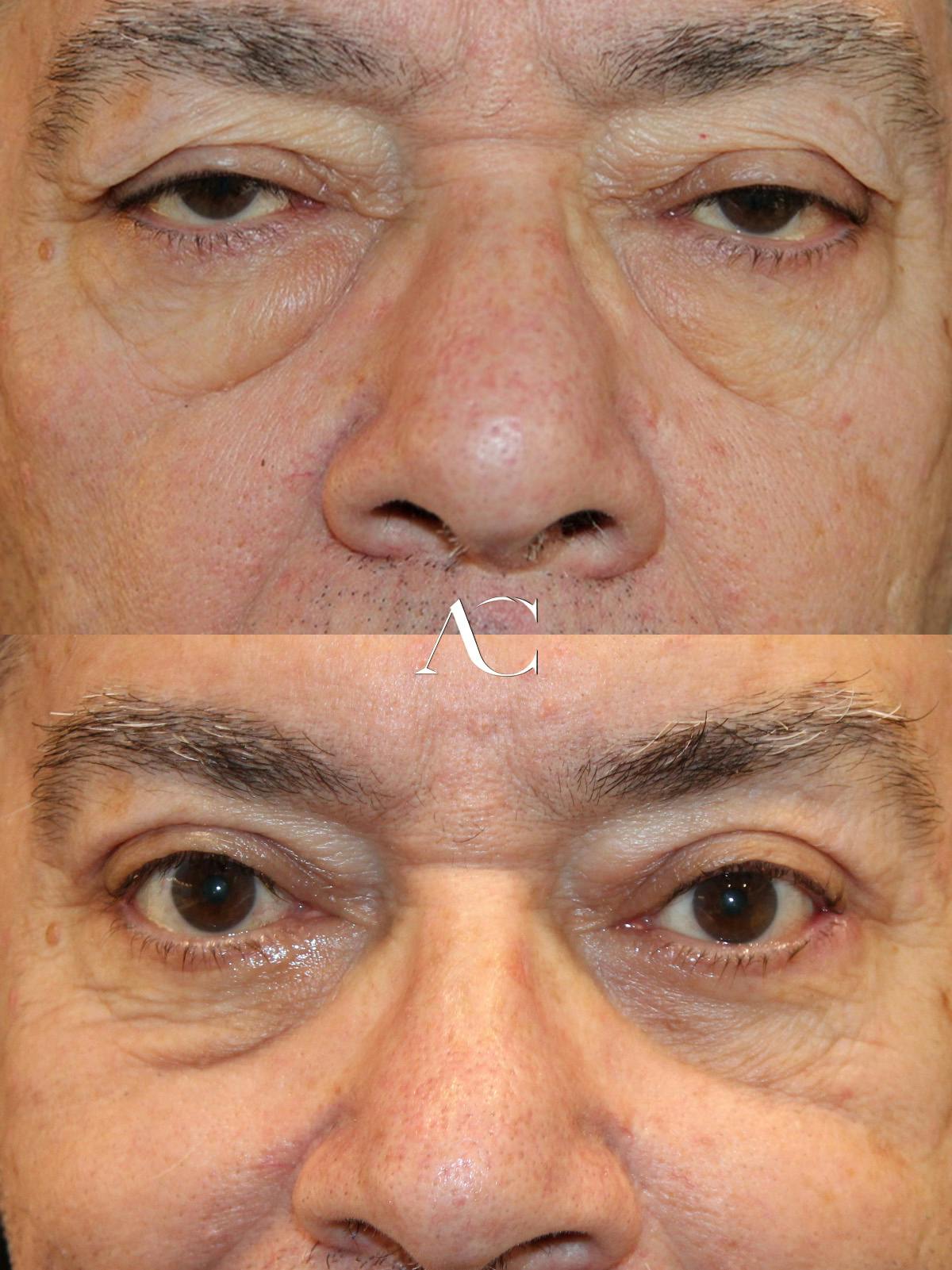 Upper Blepharoplasty Before & After Gallery - Patient 411436 - Image 1