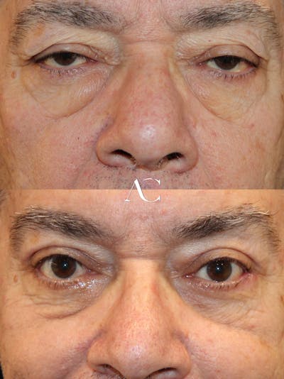 Upper Blepharoplasty Before & After Gallery - Patient 411436 - Image 1
