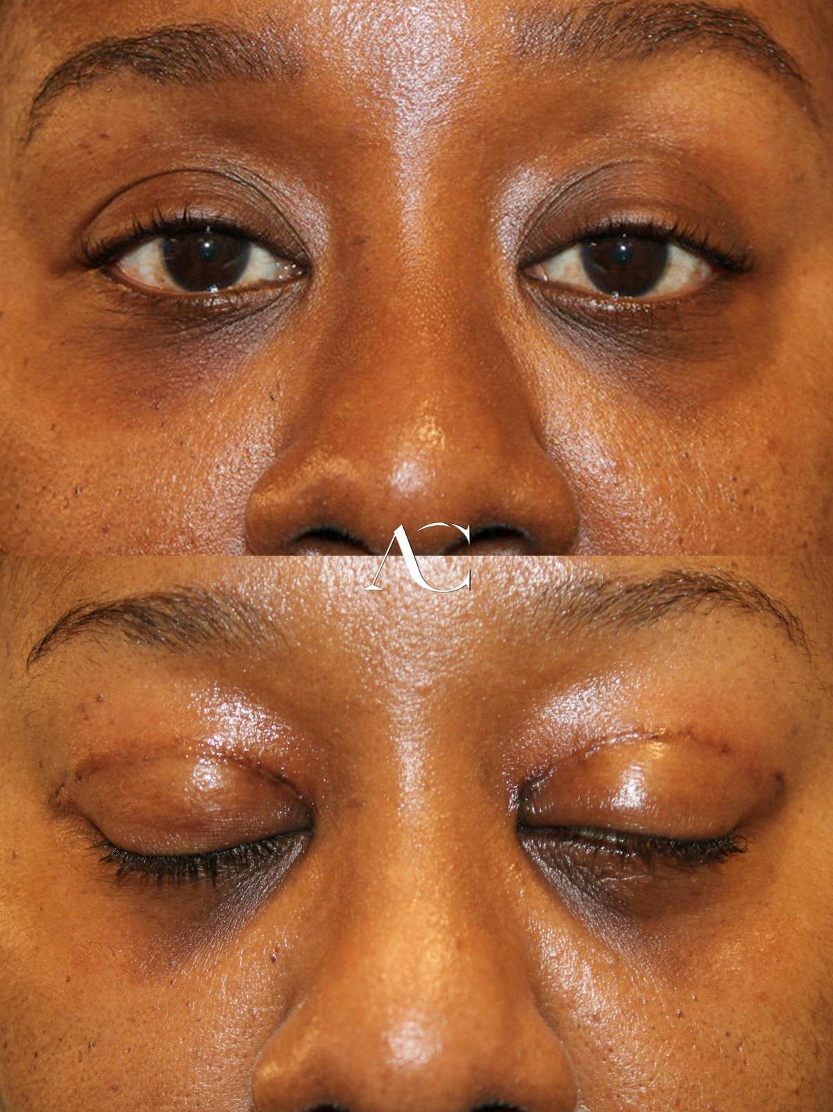 Upper Blepharoplasty Before & After Gallery - Patient 595647 - Image 1