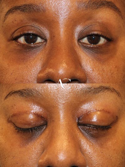 Upper Blepharoplasty Before & After Gallery - Patient 595647 - Image 1