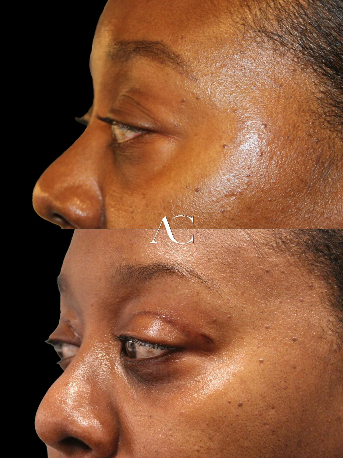 Upper Blepharoplasty Before & After Gallery - Patient 595647 - Image 2