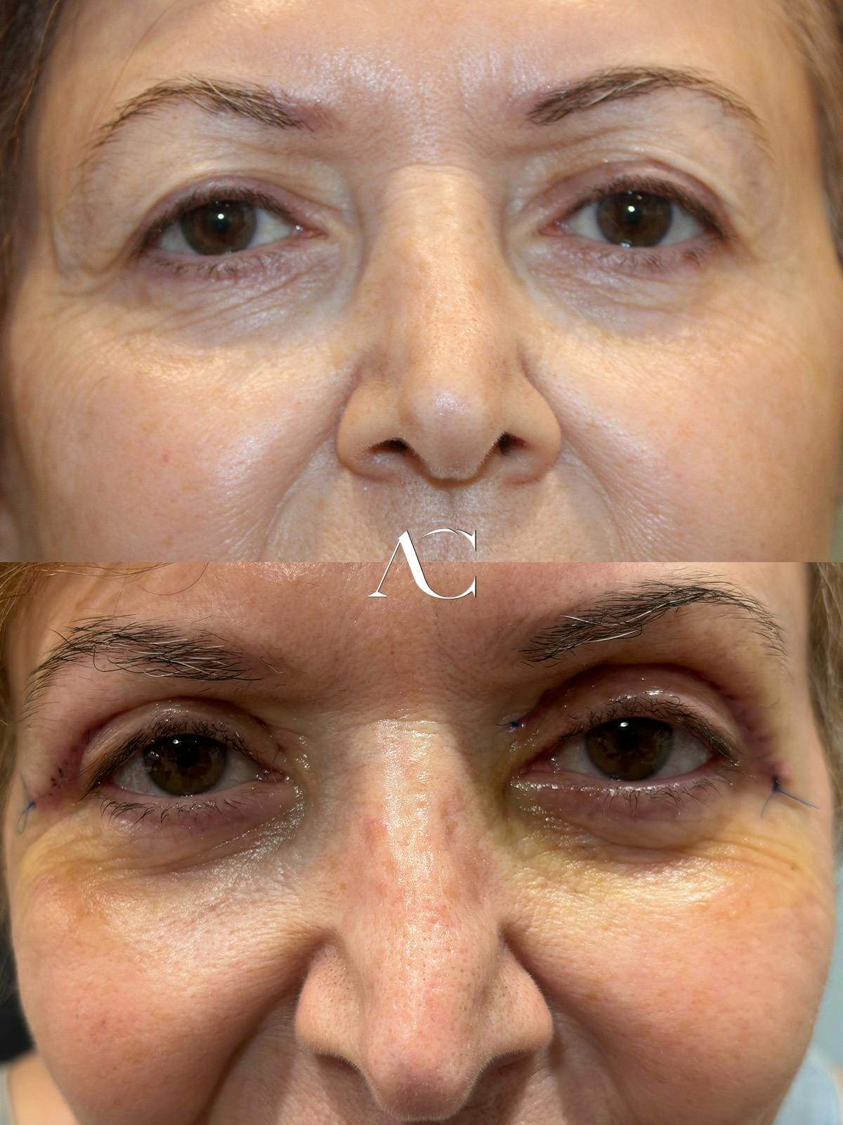Upper Blepharoplasty Before & After Gallery - Patient 136795 - Image 1