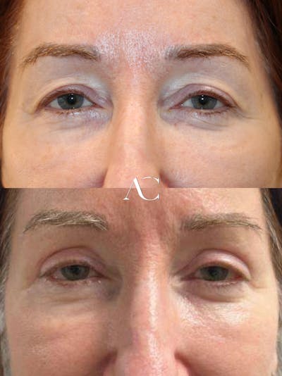 Upper Blepharoplasty Before & After Gallery - Patient 217692 - Image 1