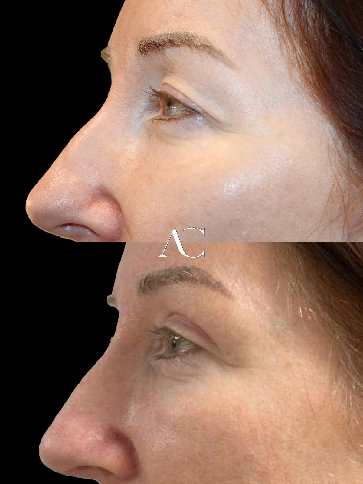 Upper Blepharoplasty Before & After Gallery - Patient 217692 - Image 2