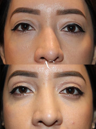 Upper Blepharoplasty Before & After Gallery - Patient 290576 - Image 1