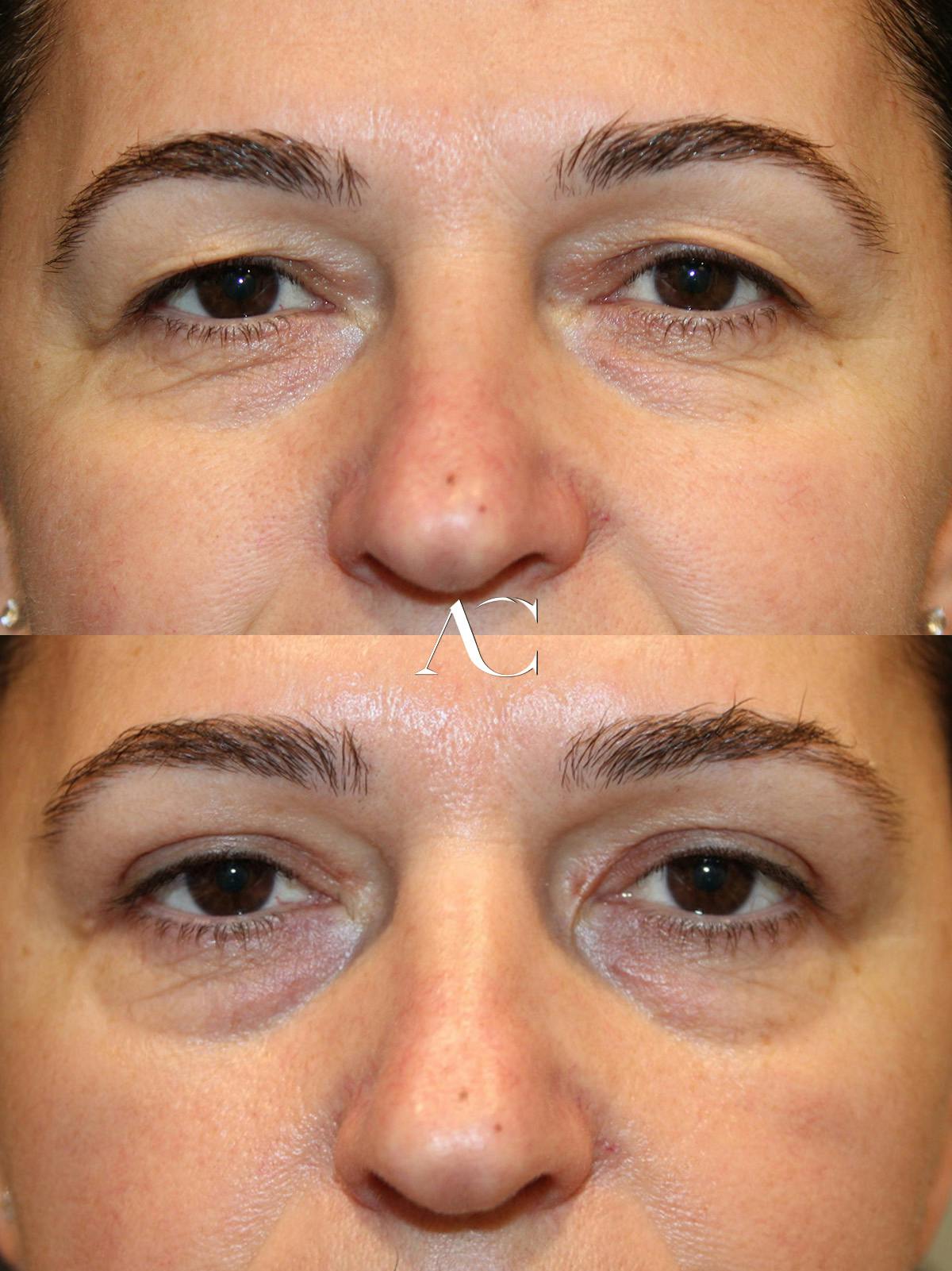Upper Blepharoplasty Before & After Gallery - Patient 416634 - Image 1