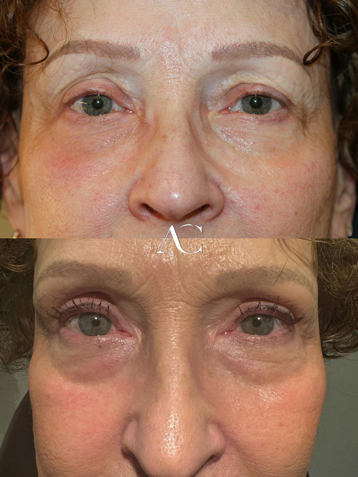 Upper Blepharoplasty Before & After Gallery - Patient 100095 - Image 1