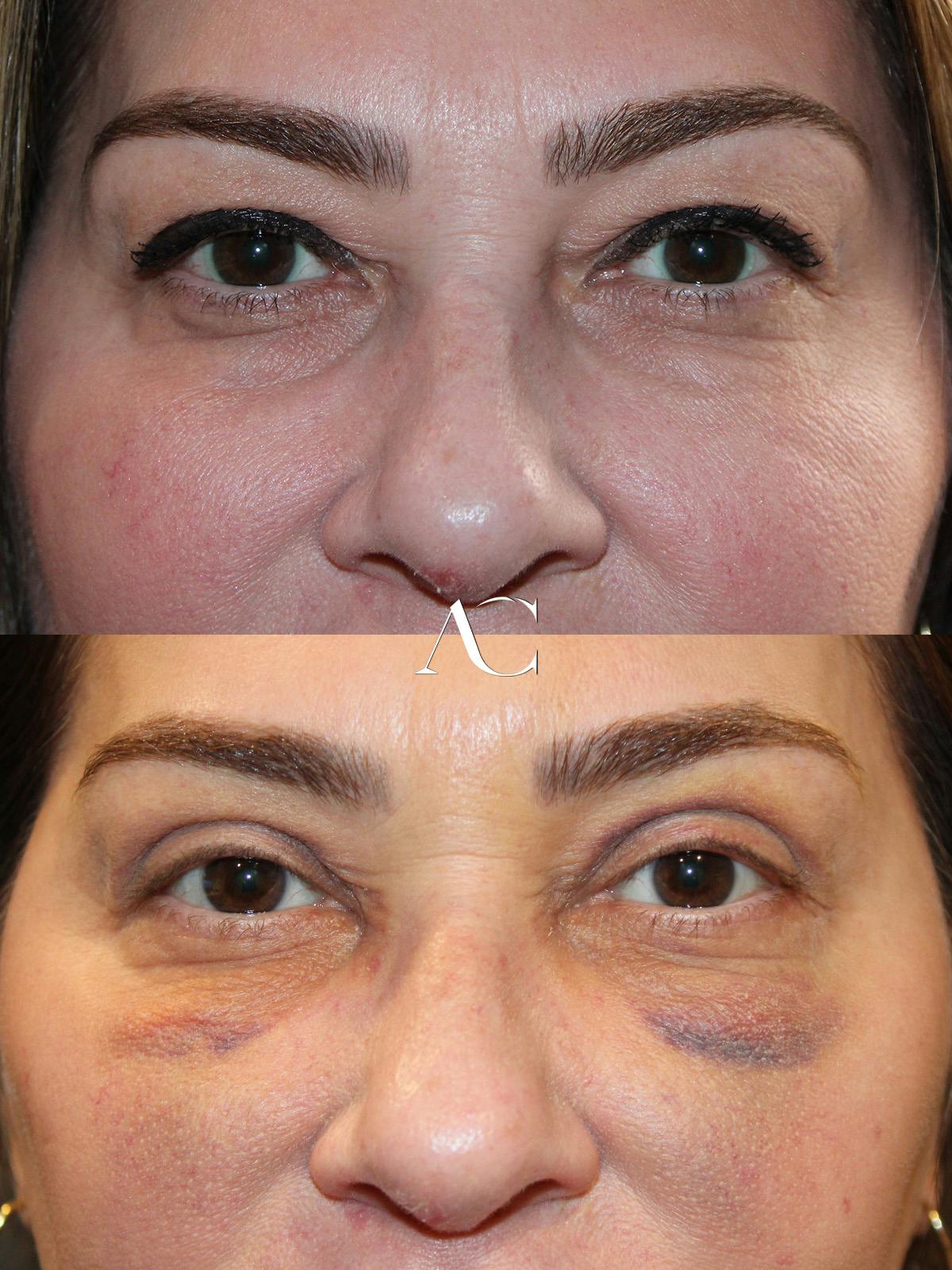 Upper Blepharoplasty Before & After Gallery - Patient 859463 - Image 1