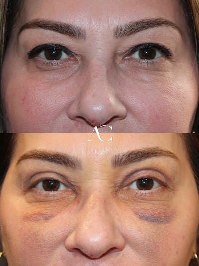 Upper Blepharoplasty Before & After Gallery - Patient 859463 - Image 1