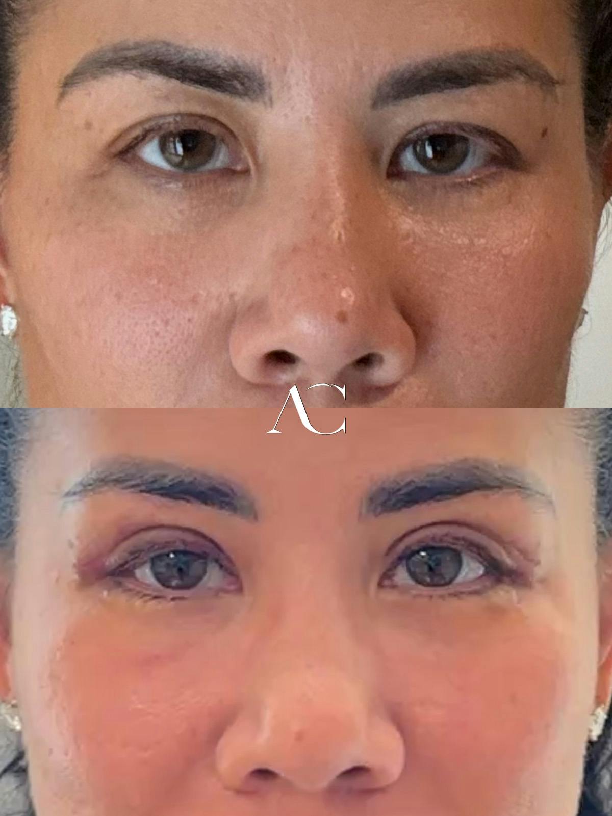Upper Blepharoplasty Before & After Gallery - Patient 256699 - Image 1