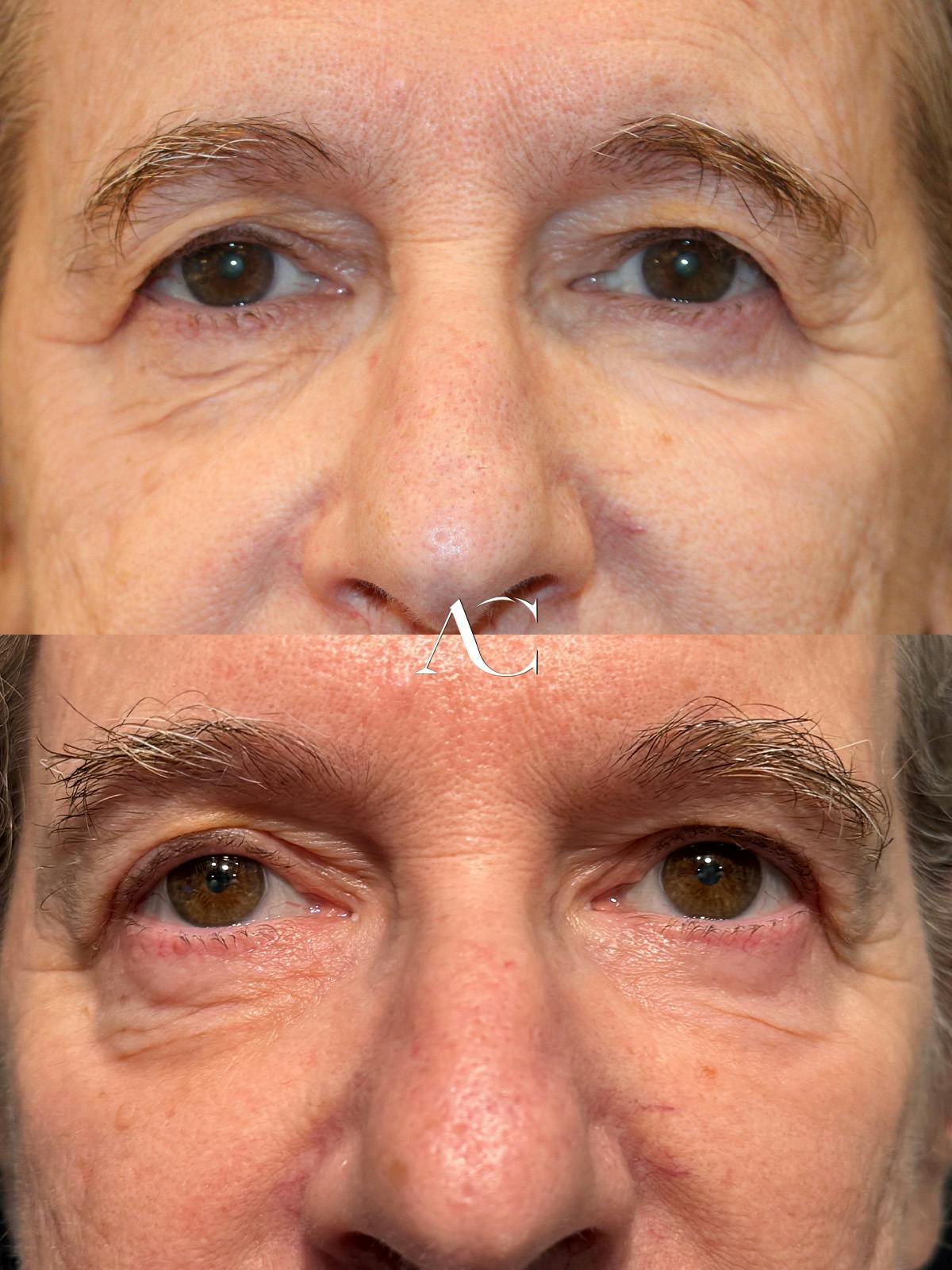 Upper Blepharoplasty Before & After Gallery - Patient 707249 - Image 1