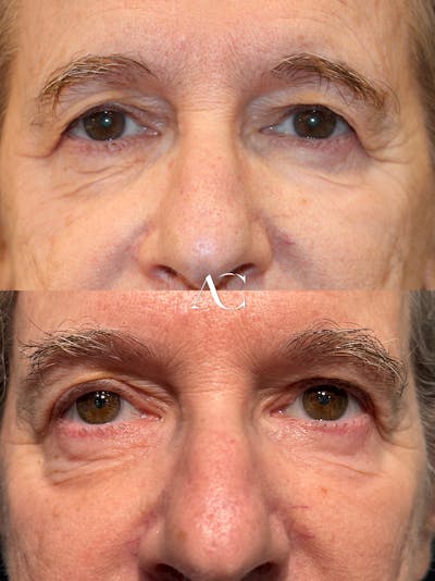 Upper Blepharoplasty Before & After Gallery - Patient 707249 - Image 1