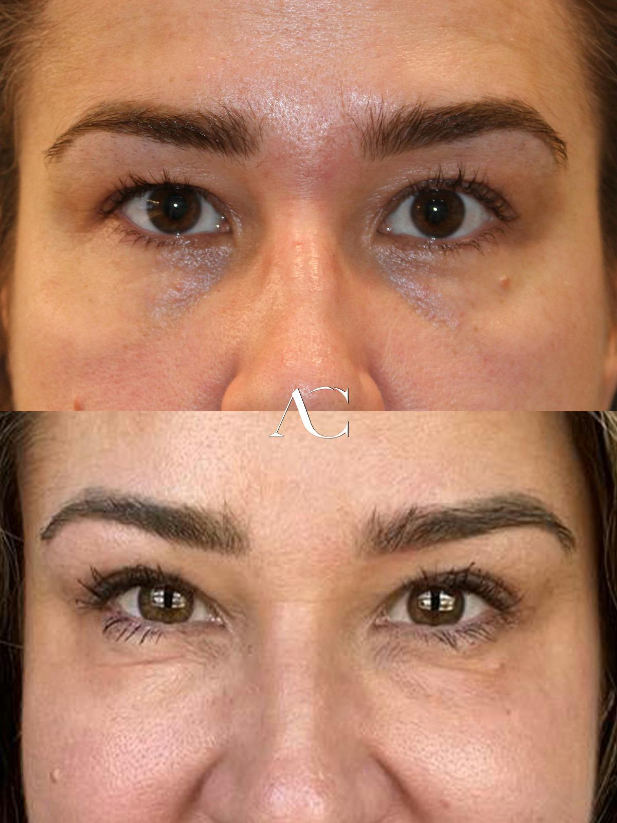 Upper Blepharoplasty Before & After Gallery - Patient 334040 - Image 1