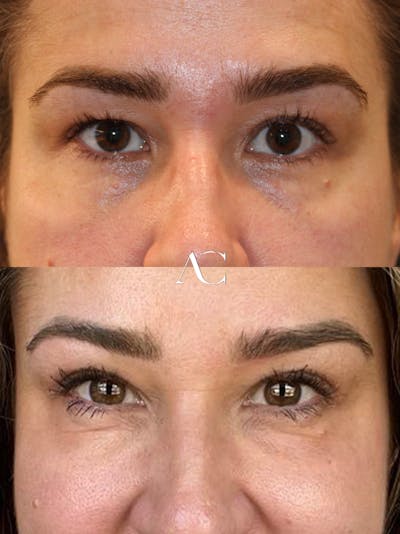 Upper Blepharoplasty Before & After Gallery - Patient 334040 - Image 1