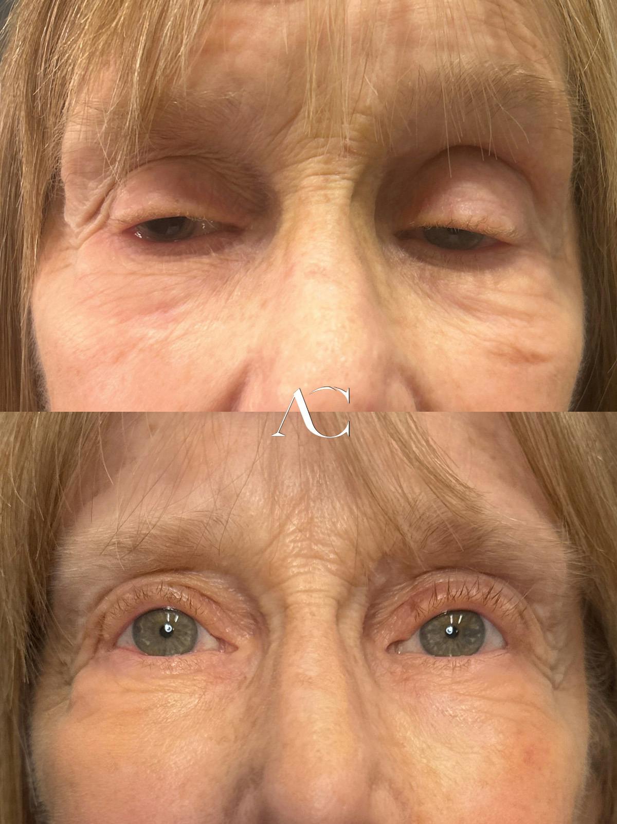 Ptosis Repair Before & After Gallery - Patient 885035 - Image 1