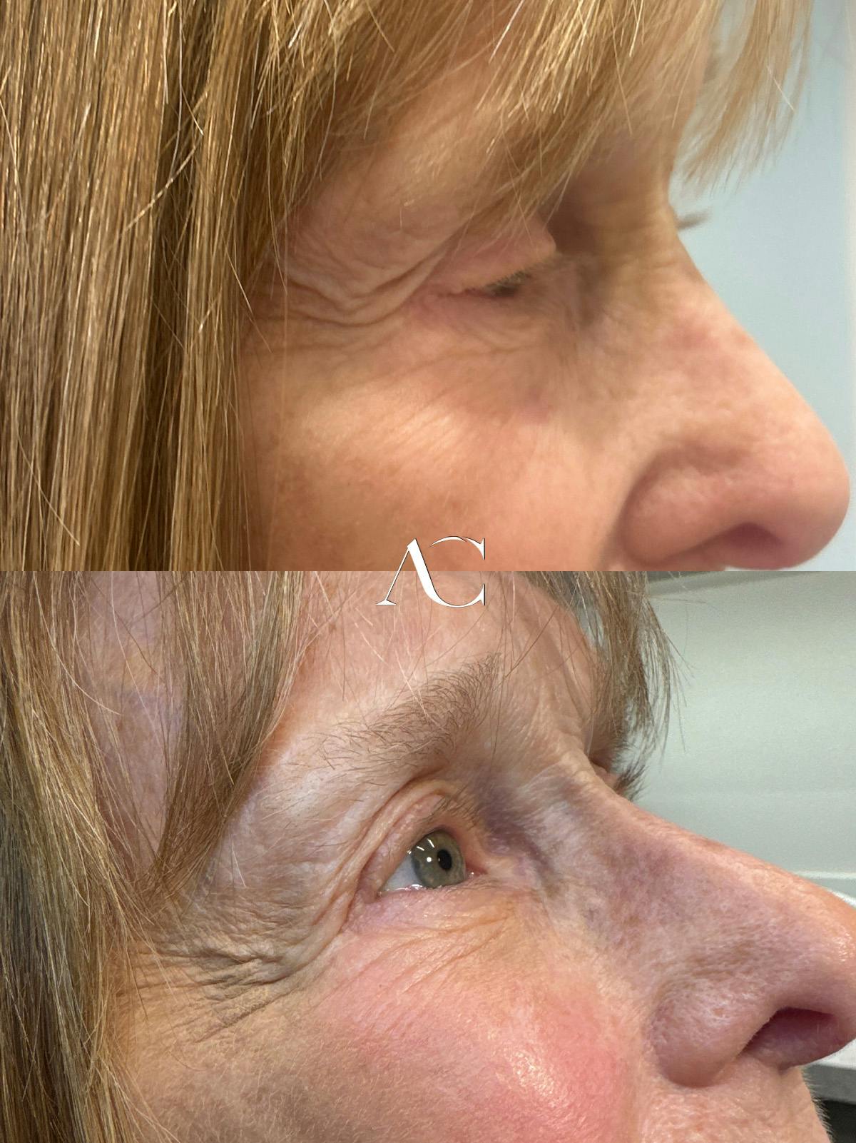 Ptosis Repair Before & After Gallery - Patient 885035 - Image 2