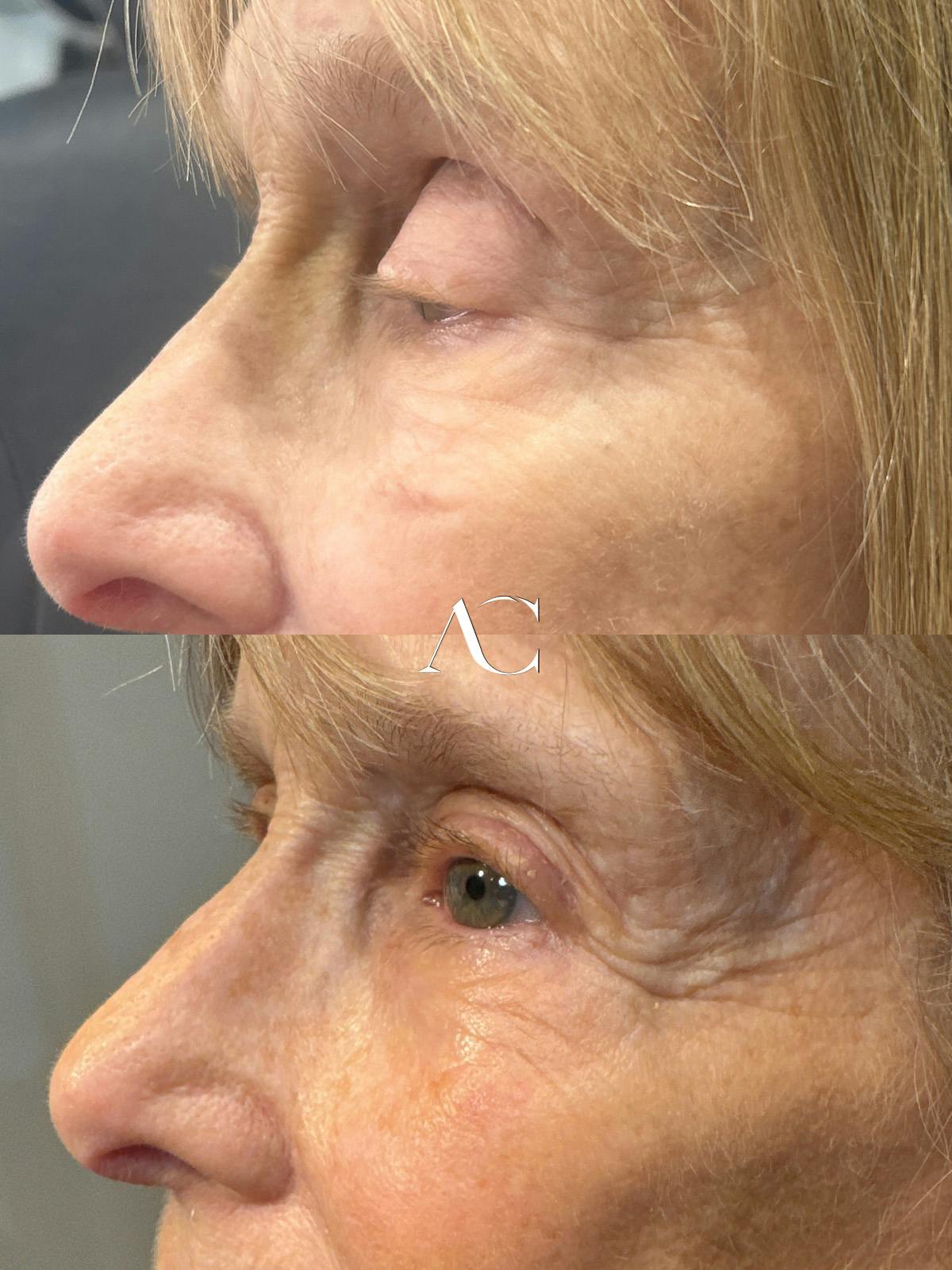 Ptosis Repair Before & After Gallery - Patient 885035 - Image 3