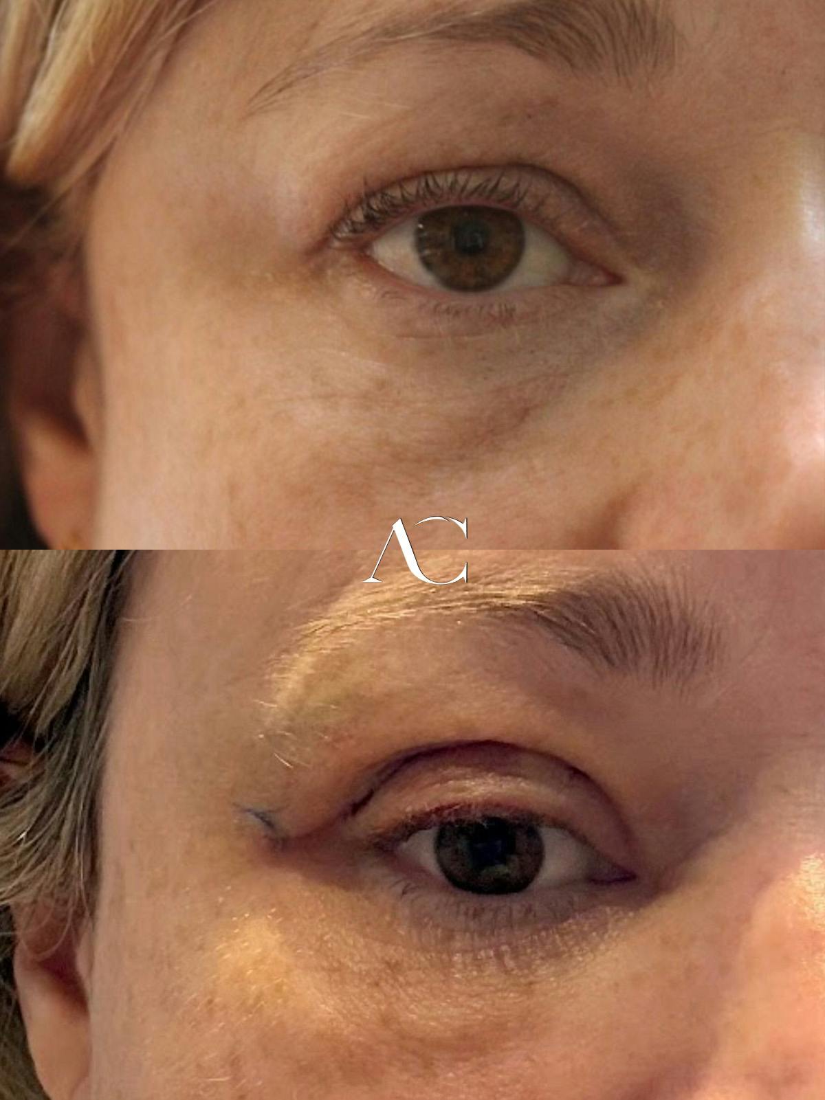 Orbital Tumors Before & After Gallery - Patient 208143 - Image 1