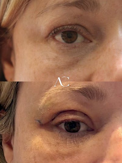 Orbital Tumors Before & After Gallery - Patient 208143 - Image 1