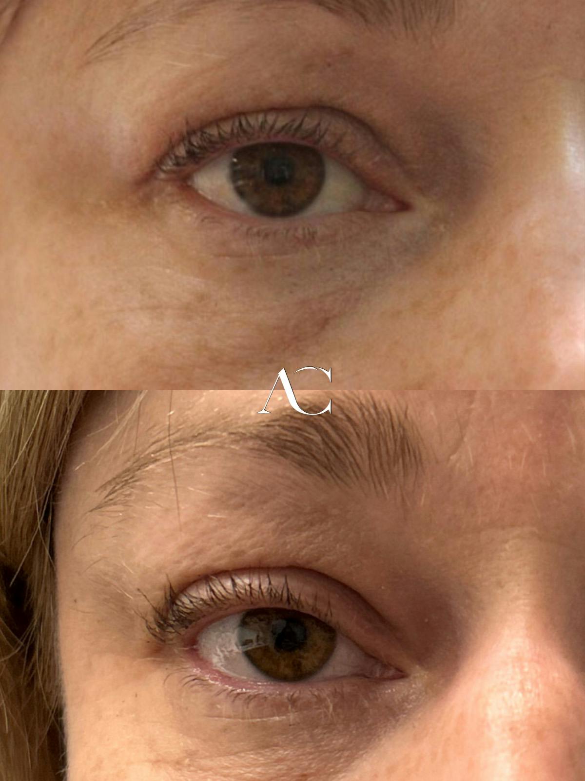 Orbital Tumors Before & After Gallery - Patient 208143 - Image 2