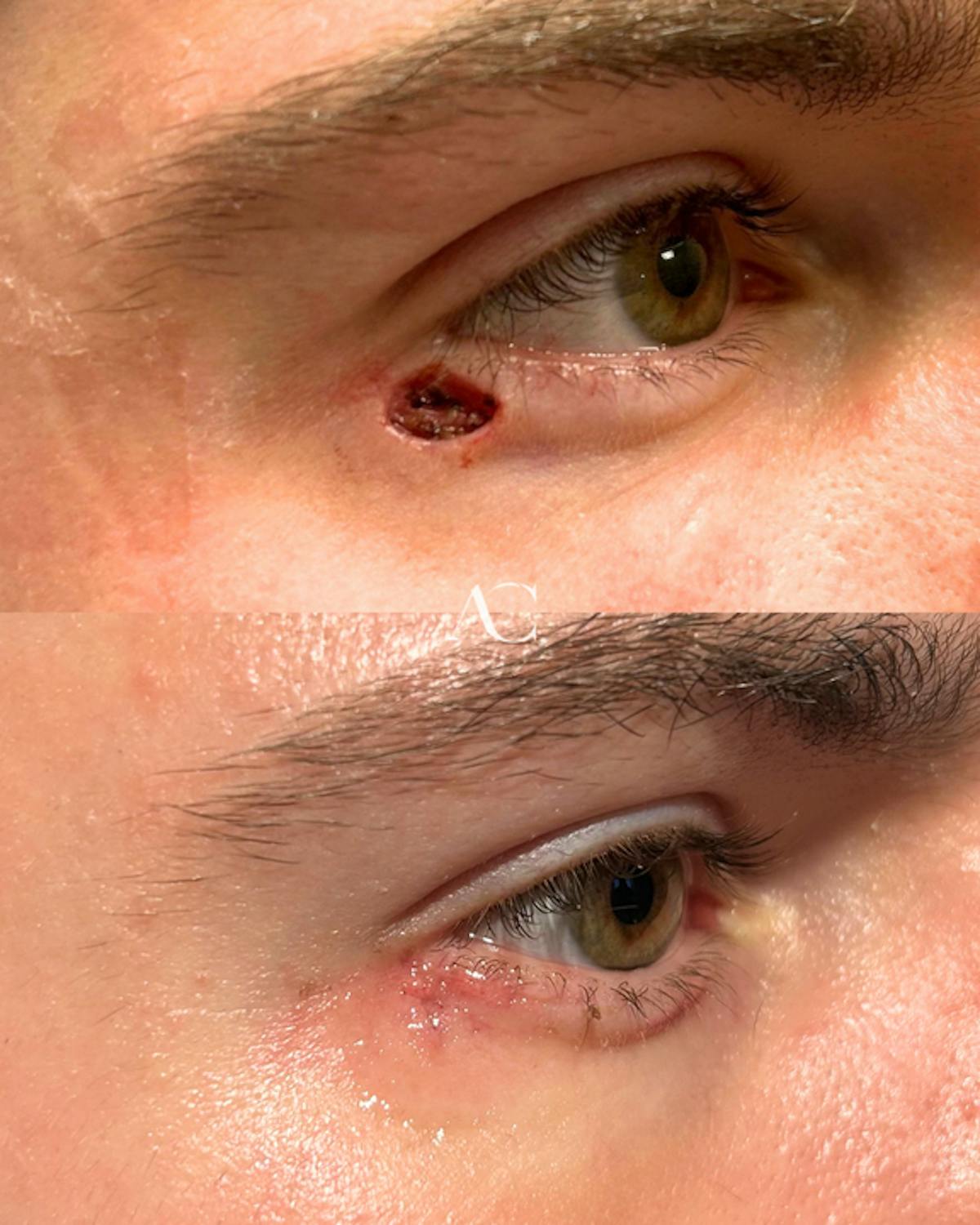 Mohs Reconstruction Before & After Gallery - Patient 137605 - Image 1