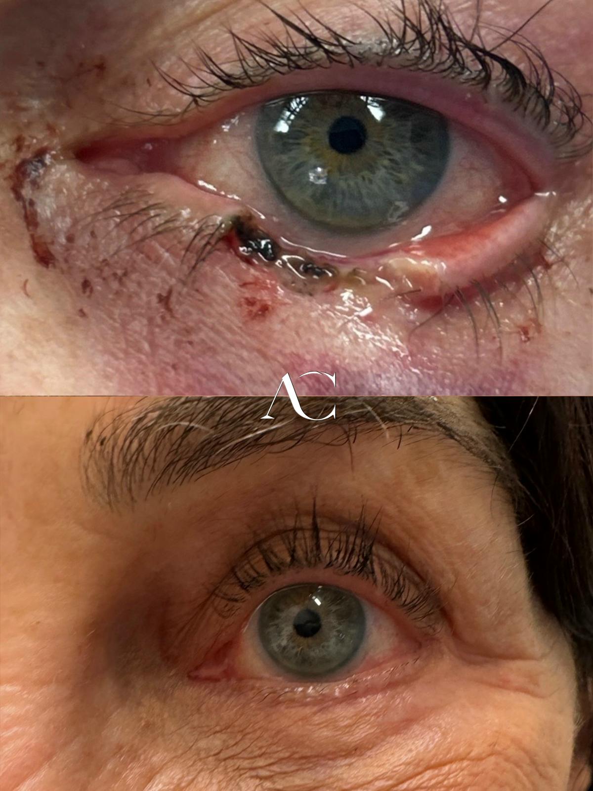 Mohs Reconstruction Before & After Gallery - Patient 193807 - Image 1