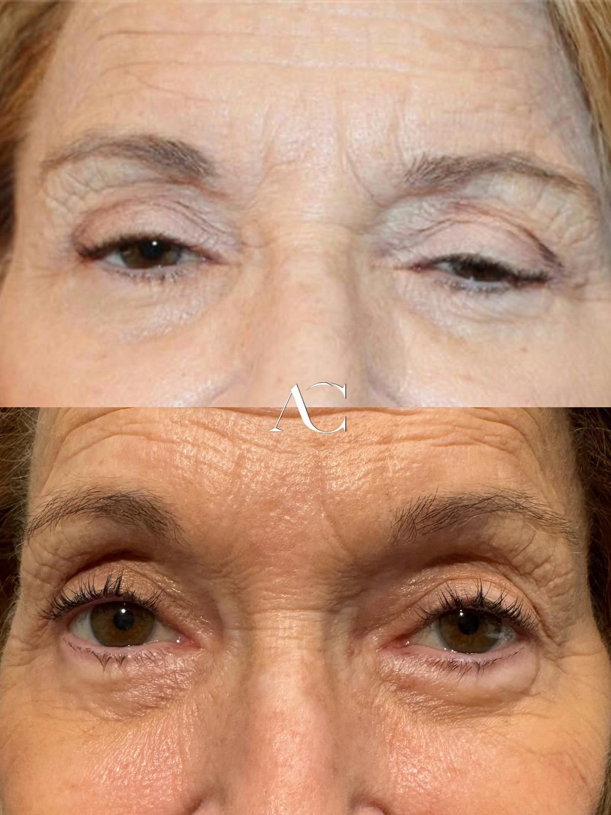 Ptosis Repair Before & After Gallery - Patient 297515 - Image 1