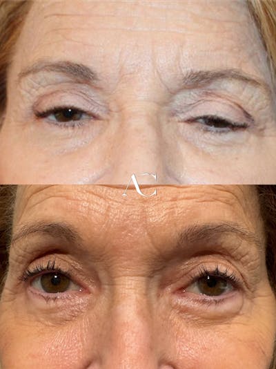 Ptosis Repair Before & After Gallery - Patient 297515 - Image 1
