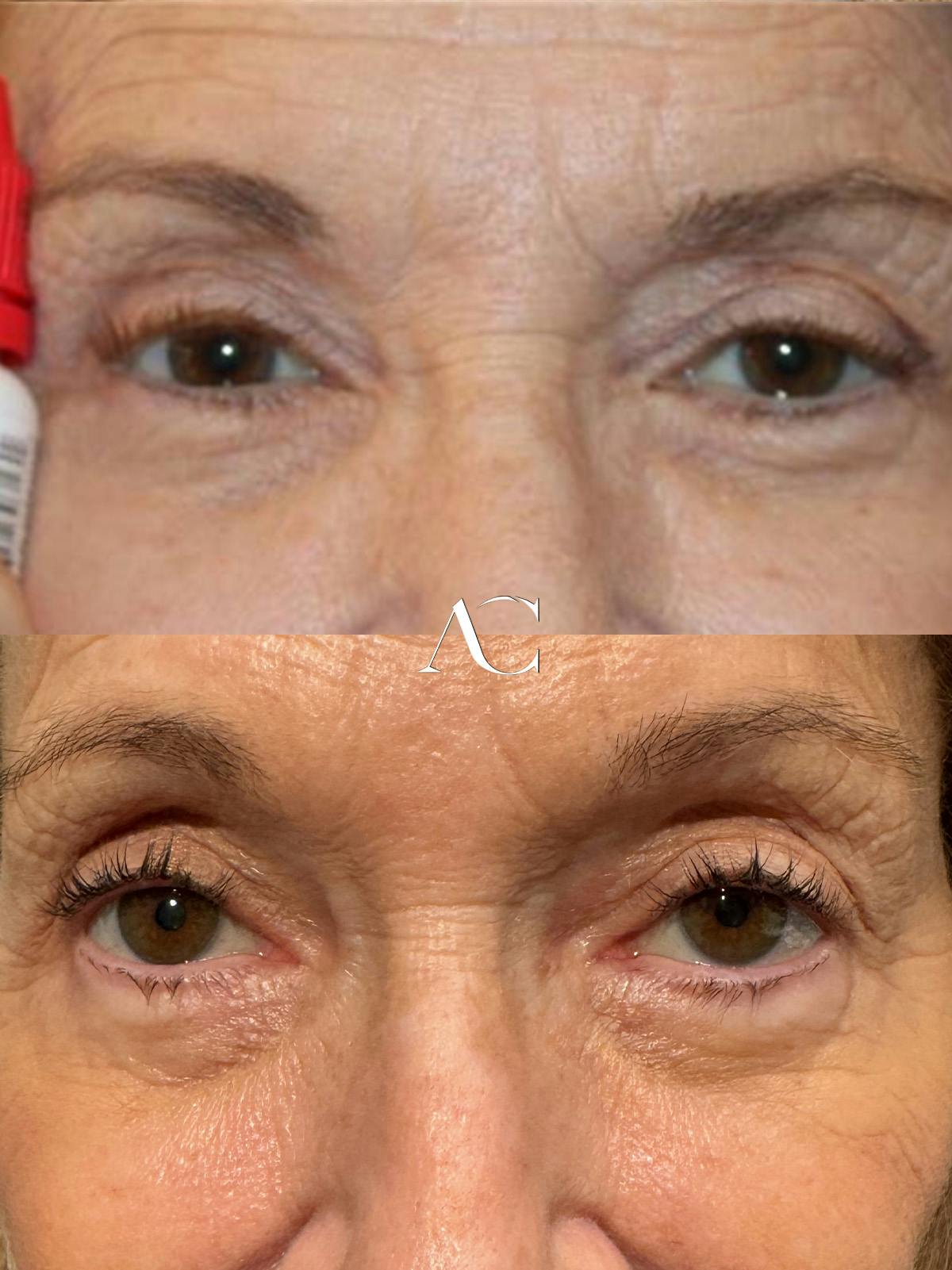 Ptosis Repair Before & After Gallery - Patient 297515 - Image 2