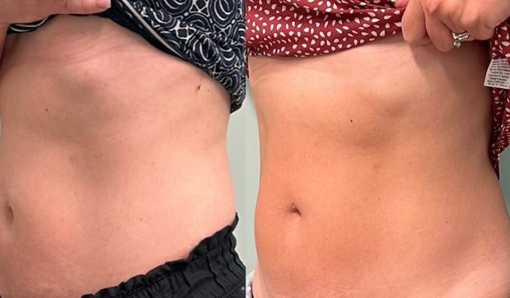 emsculpt results