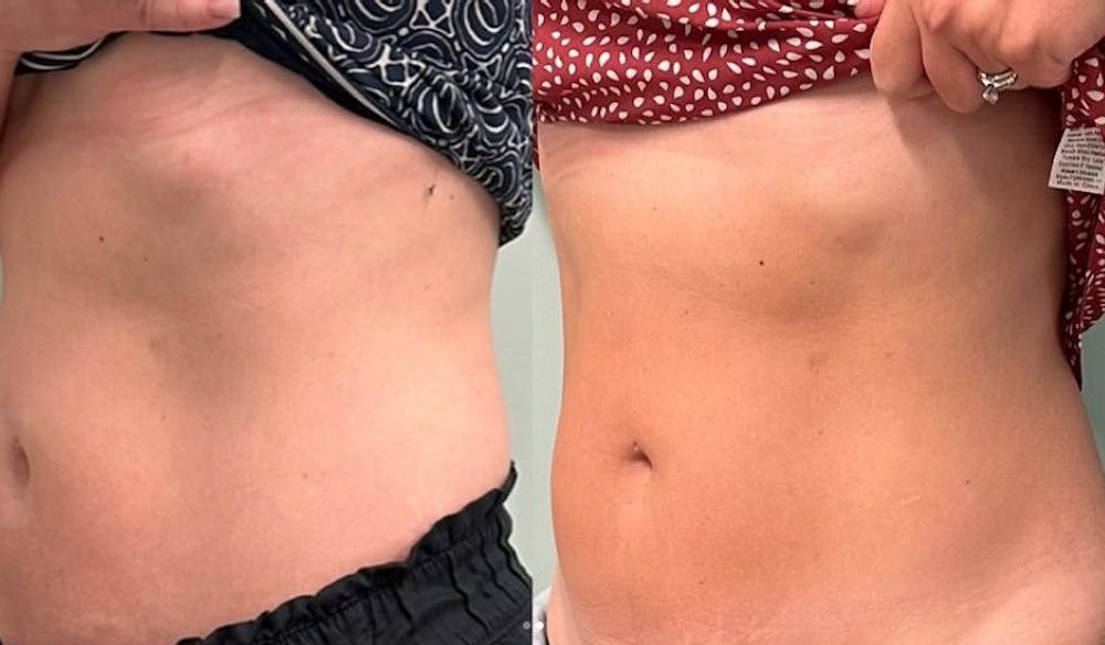 emsculpt results