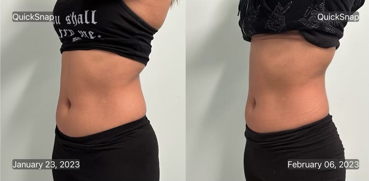 Emsculpt Before & After Gallery - Patient 347888 - Image 2