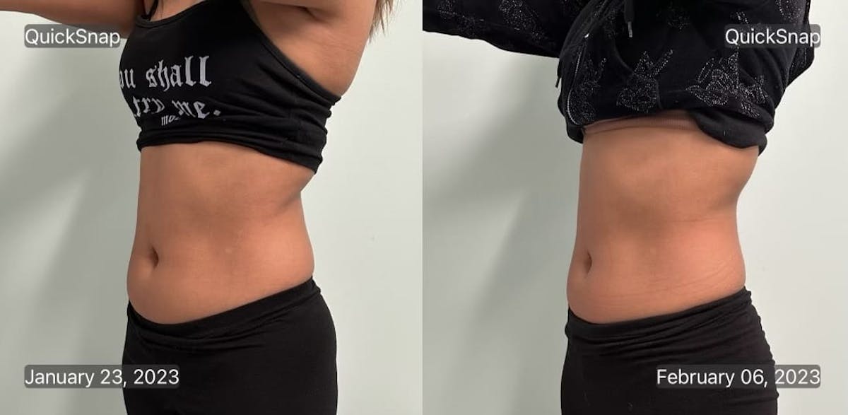 Emsculpt Before & After Gallery - Patient 347888 - Image 4