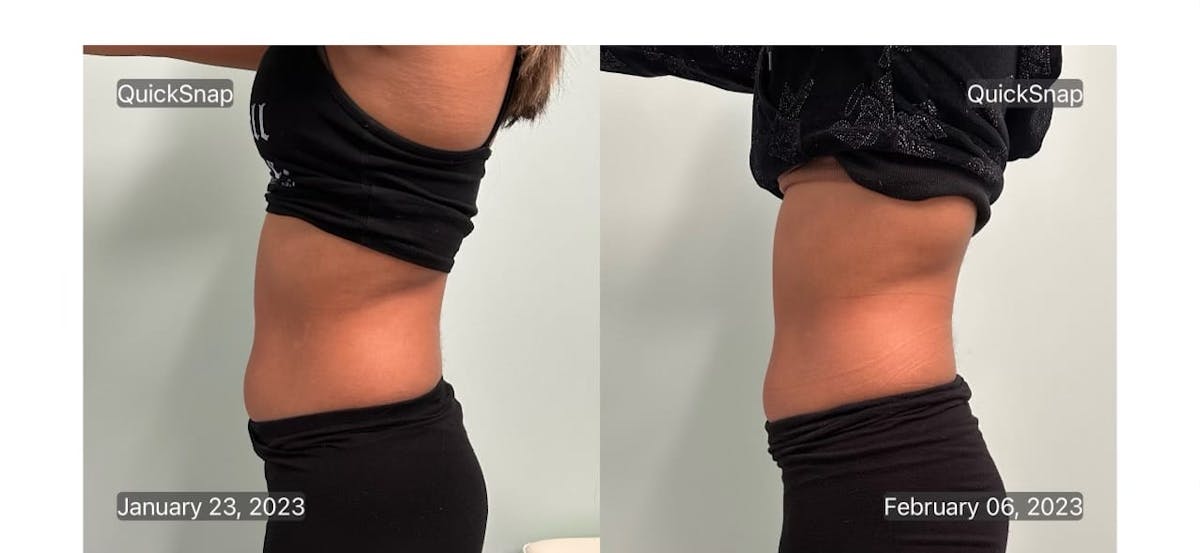 Emsculpt Before & After Gallery - Patient 347888 - Image 5
