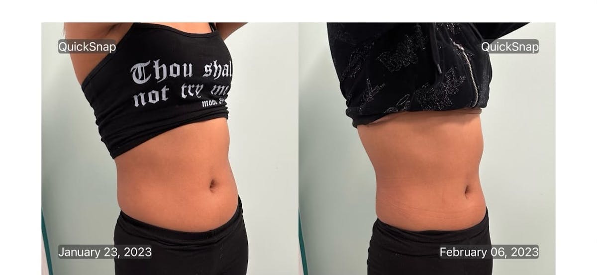 Emsculpt Before & After Gallery - Patient 347888 - Image 3