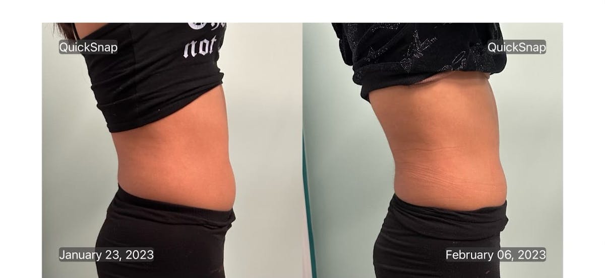 Emsculpt Before & After Gallery - Patient 347888 - Image 1