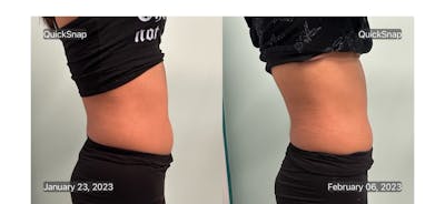 Emsculpt Before & After Gallery - Patient 347888 - Image 1