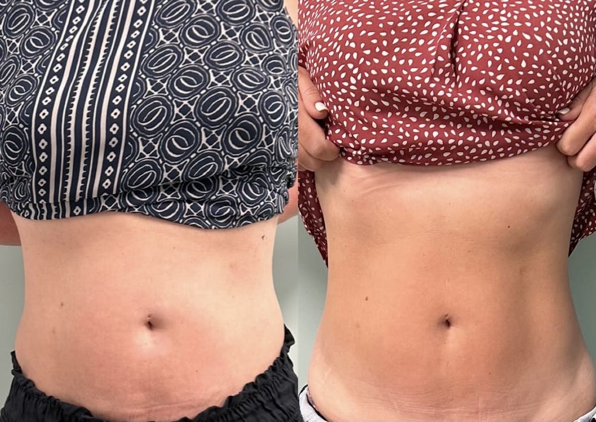 Emsculpt Before & After Gallery - Patient 260542 - Image 2