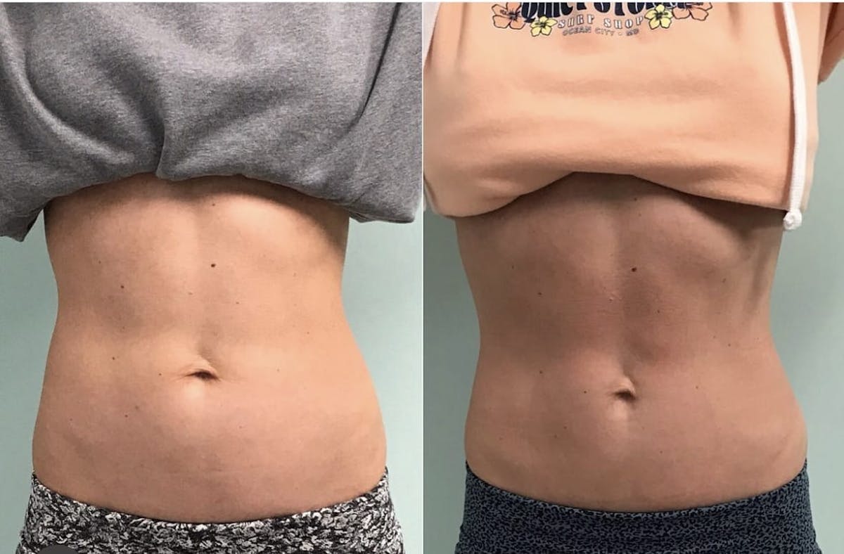 Emsculpt Before & After Gallery - Patient 260542 - Image 3
