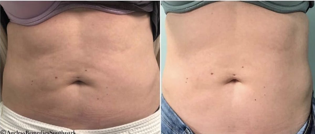 Emsculpt Before & After Gallery - Patient 260542 - Image 1
