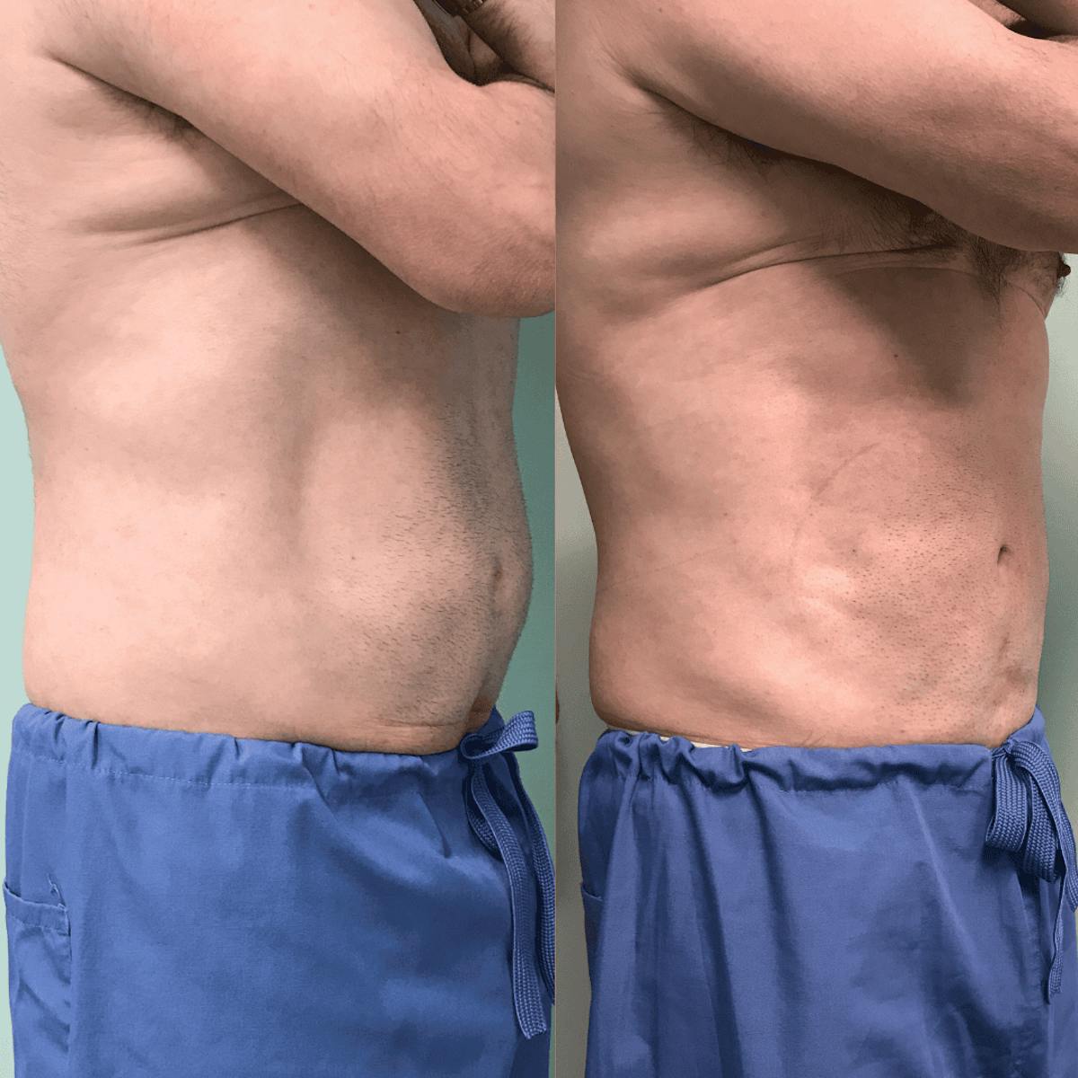 Emsculpt Before & After Gallery - Patient 753274 - Image 1