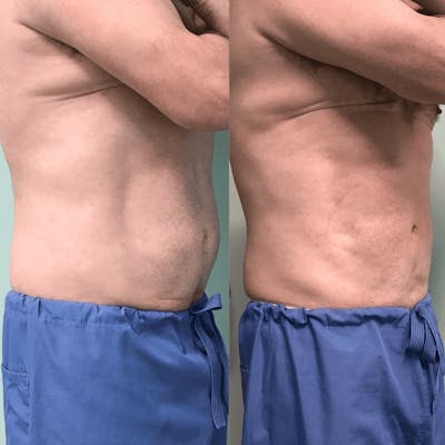 Emsculpt Before & After Gallery - Patient 753274 - Image 1