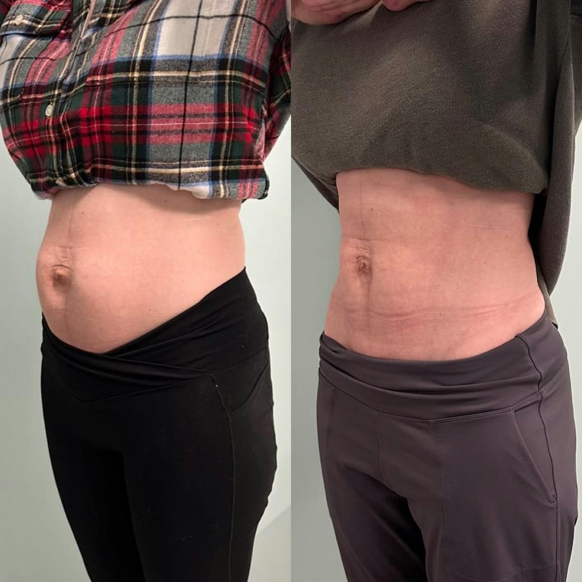 Emsculpt Before & After Gallery - Patient 572553 - Image 5